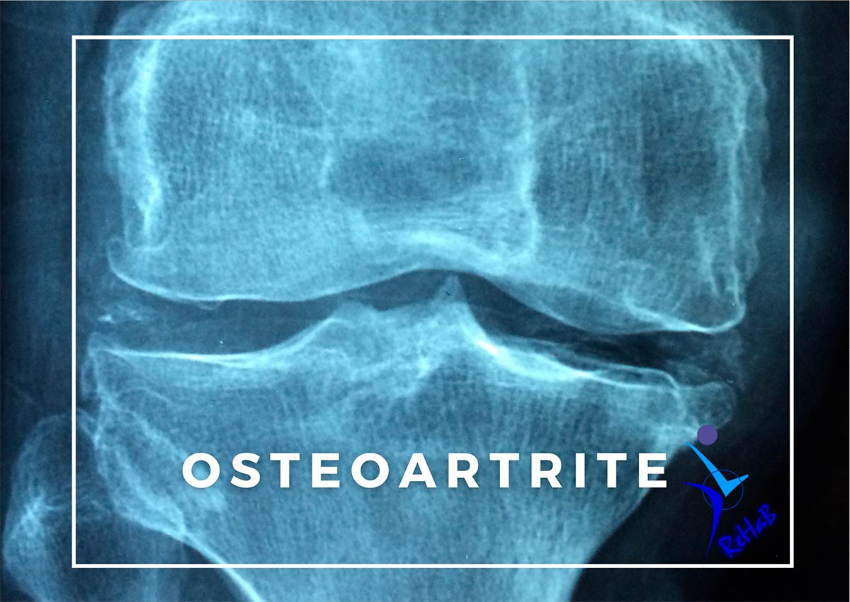 post-osteoatrite